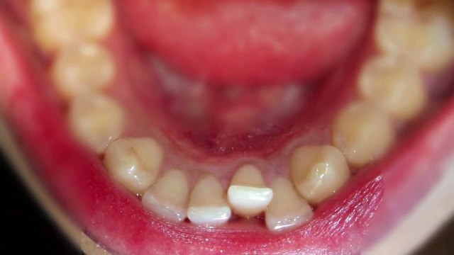 Successful teeth straightening experience | Inman aligner