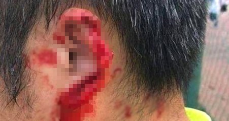 Çin'de Futbolcu Kavga Ettiği Rakibinin Kulağını Isırarak Kopardı