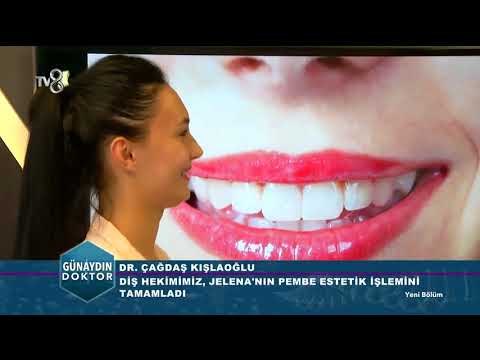 Pembe estetik ve bonding öncesi ve sonrası?