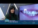 Çürük Diş Tedavisi | Günaydın Doktor