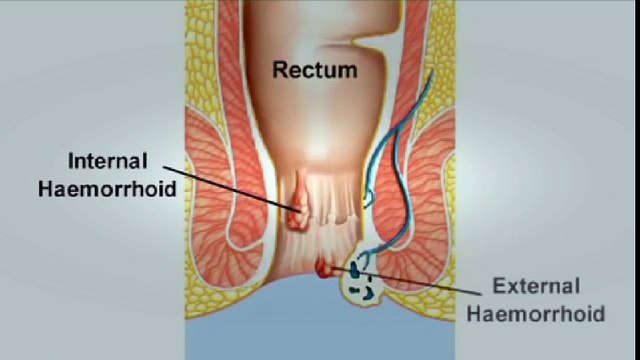 BEST Hemorrhoids Treatment | How To Get Rid of Hemorrhoids FAST? Piles Treatments, Hemorrhoid Cream! | Hemorrhoid Treatment