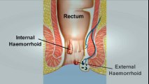 BEST Hemorrhoids Treatment | How To Get Rid of Hemorrhoids FAST? Piles Treatments, Hemorrhoid Cream! | Hemorrhoid Treatment