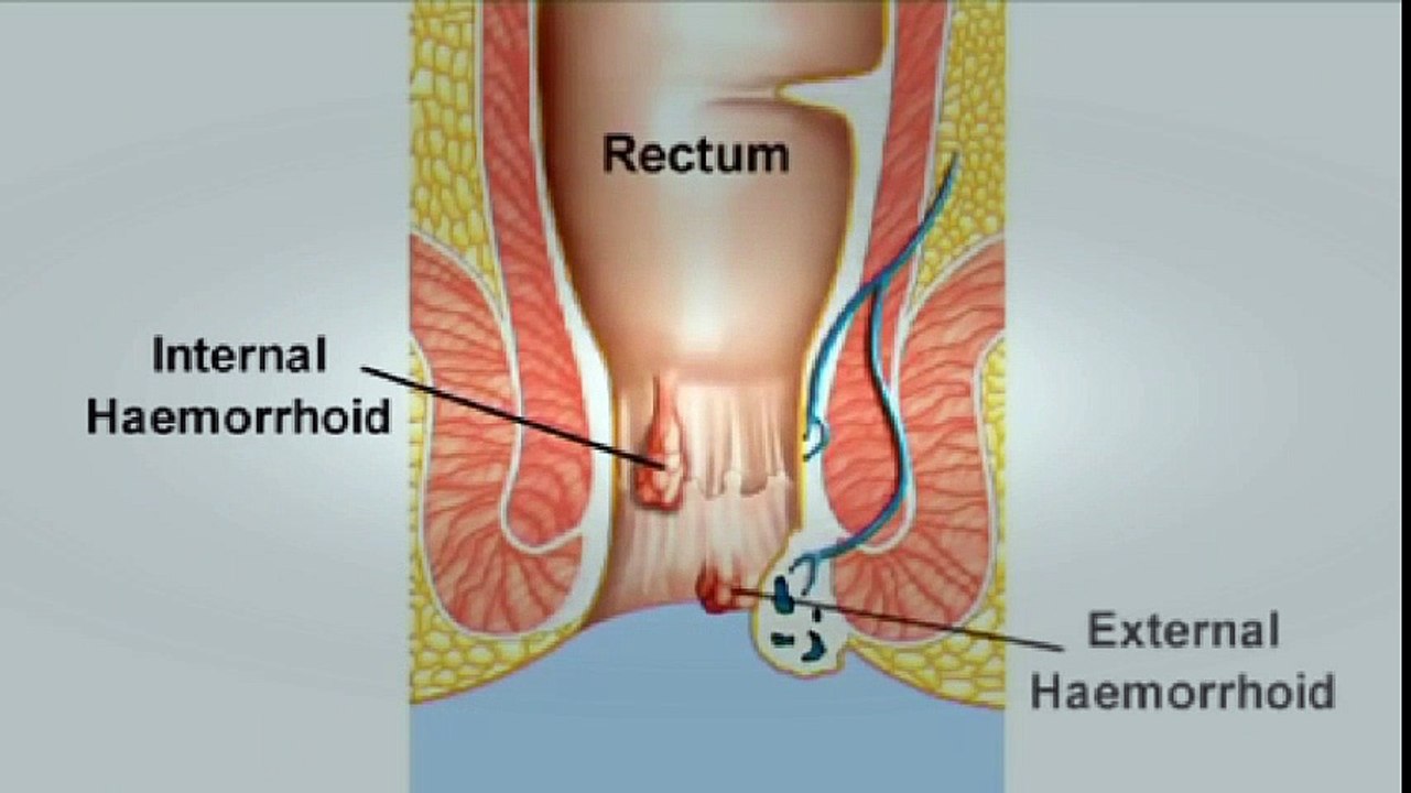 BEST Hemorrhoids Treatment | How To Get Rid of Hemorrhoids FAST? Piles Treatments, Hemorrhoid Cream! | Hemorrhoid Treatment