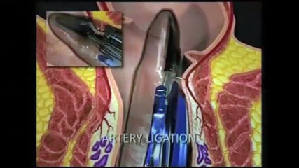 New Treatment for Hemorrhoids - Borgess Medical Center | Hemorrhoid Treatment