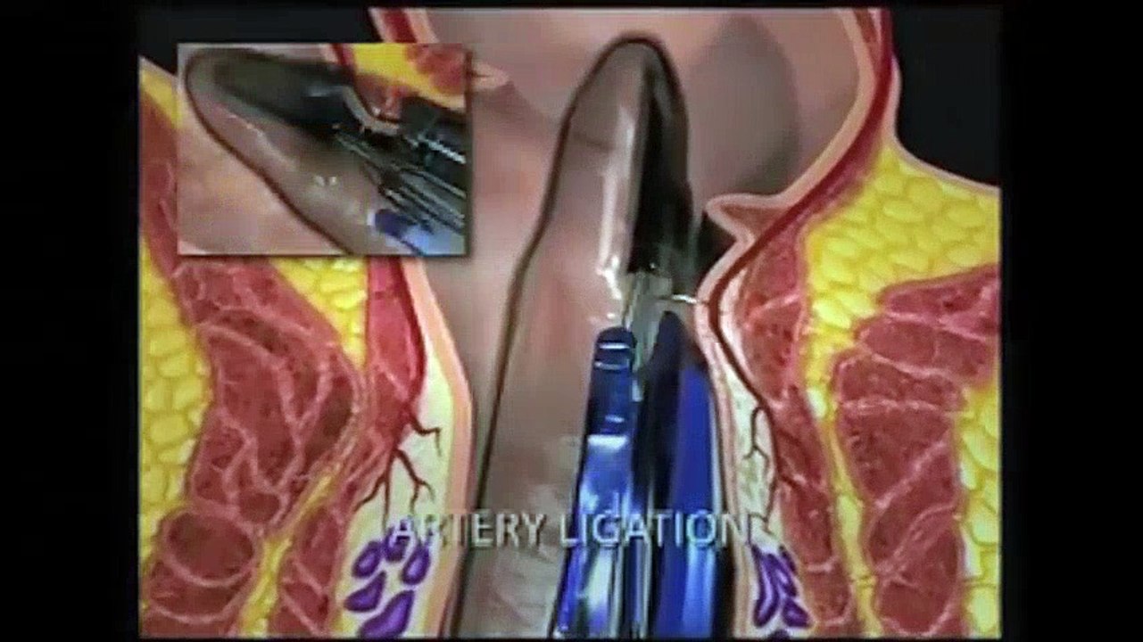 New Treatment for Hemorrhoids - Borgess Medical Center | Hemorrhoid Treatment