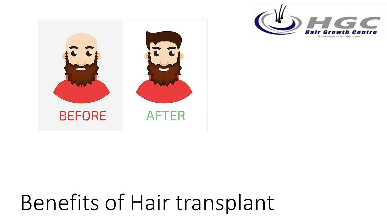 Benefits of Hair transplant