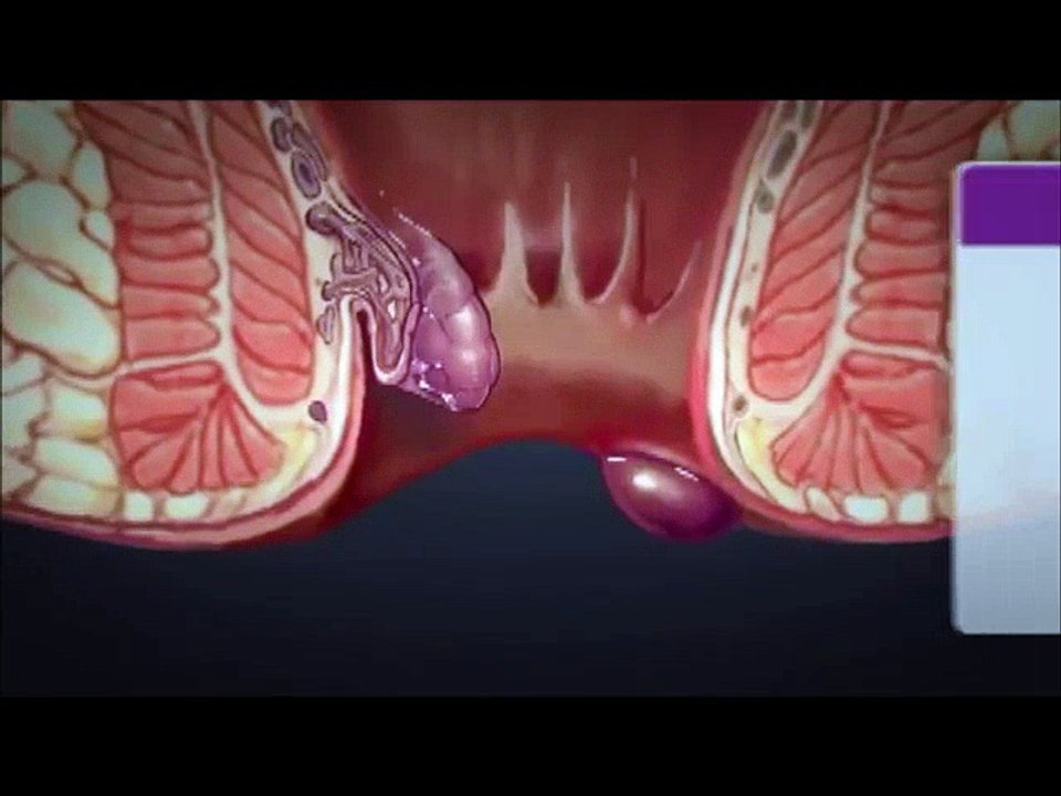 HEMORRHOiDS | What are hemorrhoids ? What is the treatment for hemorrhoids ? | Hemorrhoid Treatment