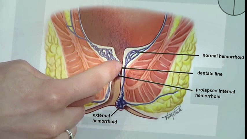 Non Surgical Hemorrhoid Treatment | Hemorrhoid Treatment