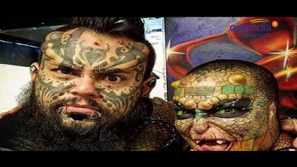 ഇതിലും വലിയ സർജറി സ്വപ്നങ്ങളിൽ മാത്രം, മനുഷ്യന്‍ വ്യാളിയായ കഥ | Oneindia Malayalam