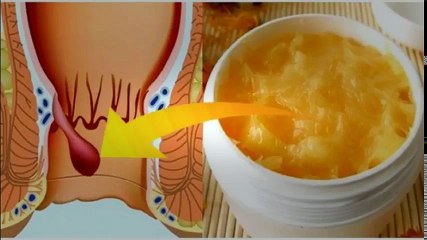 Hemorrhoid Ointment - Ointments For Hemorrhoids | Hemorrhoid Treatment