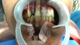 How crowns repair cracked or broken teeth ? || Partha Dental ||