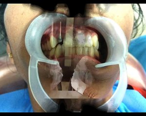 How crowns repair cracked or broken teeth ? || Partha Dental ||