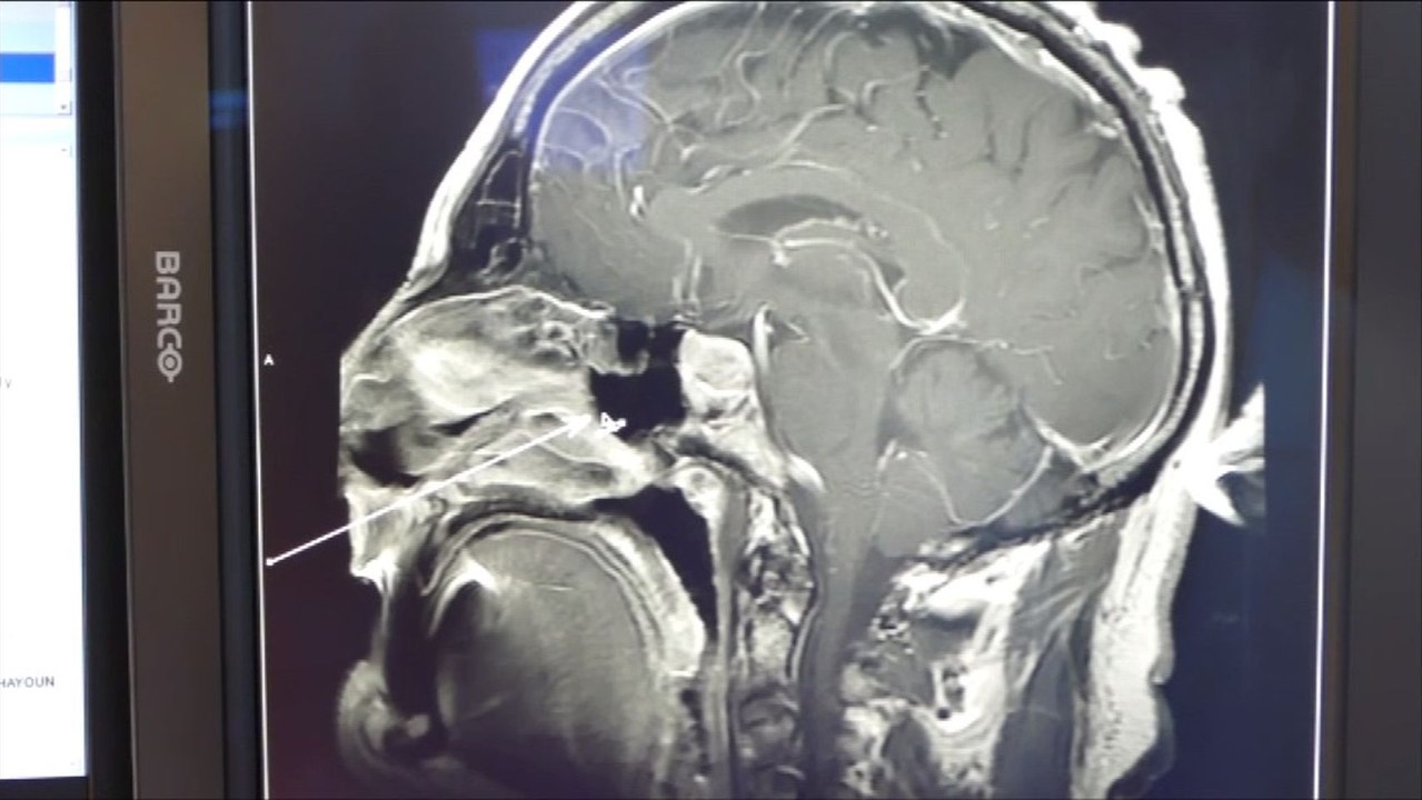 Extracción de un tumor en la hipófisis por la nariz.