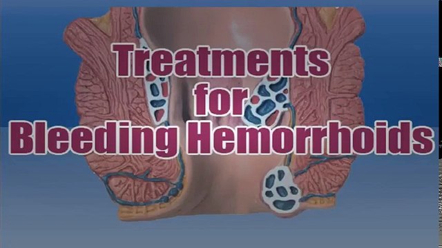 Bleeding Hemorrhoids Treatment - How To Stop Bleeding Hemorrhoids || Treating Hemorrhoids At Home | Hemorrhoid Treatment