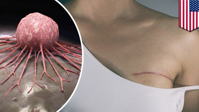 Breast cancer: Post-surgery healing could trigger relapse - TomoNews
