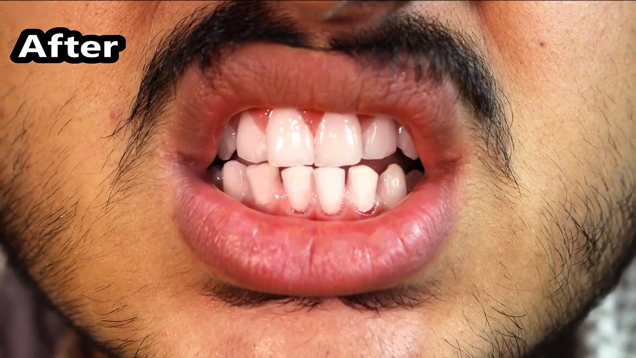 58.I applied This Teeth Whitening Remedy for 5 Days-My Dentist Was Shocked