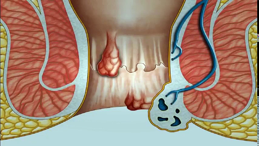 Prolapsed Hemorrhoids Treatment – Prolapsed Hemorrhoid Treatment At Home Without Surgery | Hemorrhoid Treatment