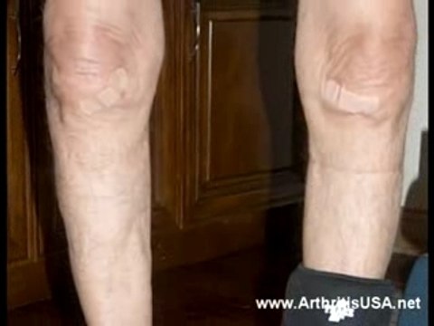 Genu Verus or Bowlegged knees by Farshchian