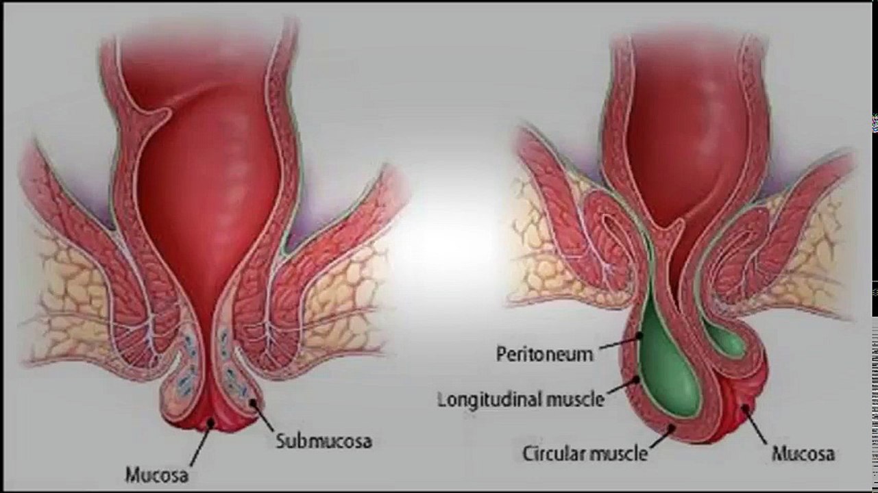 Treating Thrombosed Hemorrhoids At Home - Thrombosed Hemorrhoids Home Treatment | Hemorrhoid Treatment