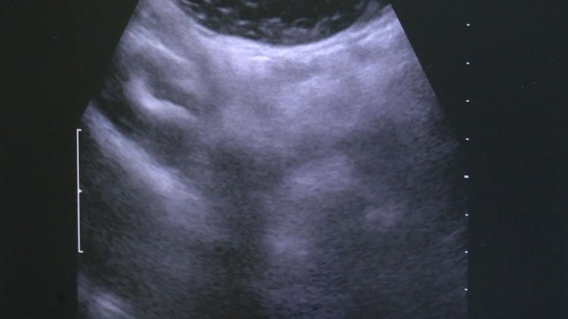 과민성 방광질환 원인 규명...새 치료제 개발 기대 / YTN