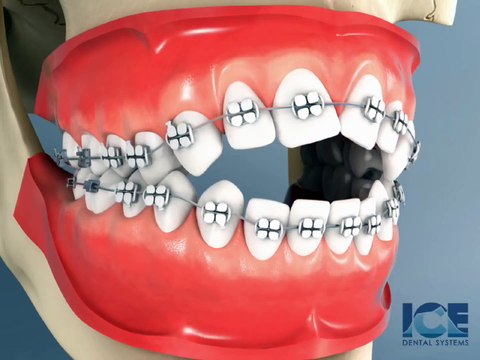 How To Use Elastics - Anterior Openbite Braces