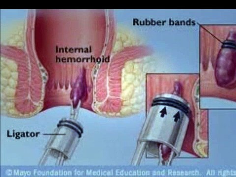 hemorrhoid symptoms - internal hemorrhoids symptoms | Hemorrhoid Treatment
