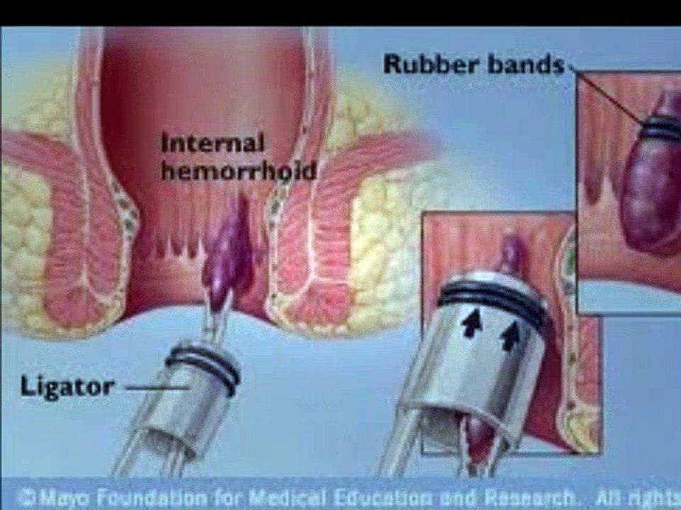 hemorrhoid symptoms - internal hemorrhoids symptoms | Hemorrhoid Treatment