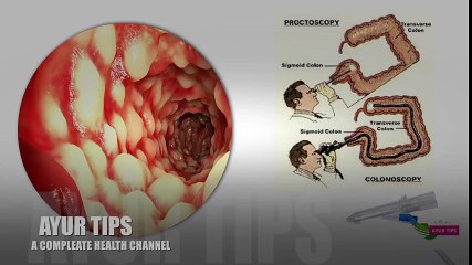 Remedy for hemorrhoids/seven diwscount ulcer completely switch | Hemorrhoid Treatment