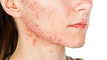 Hamileyken "Yüzünde Niye Sivilce Var" Diyerek Dalga Geçen Eşine Boşanma Davası Açtı