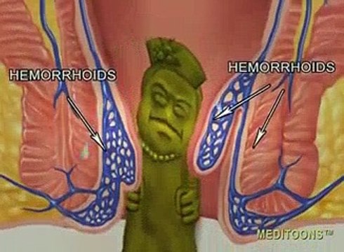What Causes Hemorrhoids? Treatment and Cure. Meditoons™ | Hemorrhoid Treatment