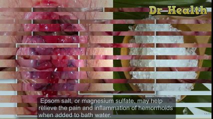 How To Cure Hemorrhoids With Epsom Salt Only After A Week | Hemorrhoid Treatment
