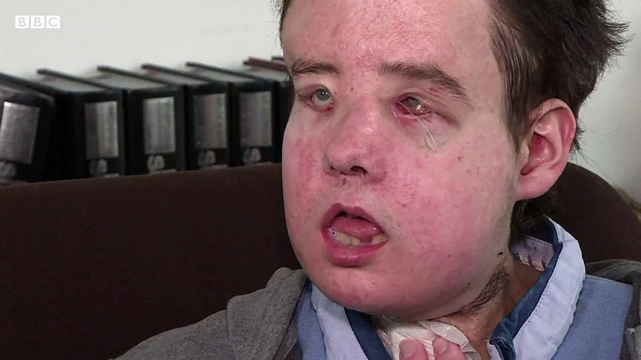 Mr Hamon is still recovering in hospital in Paris after the January transplant