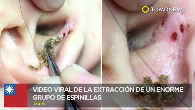 Asquerosidades del cuerpo: Extracción de espinillas en Taiwán asqueroso pero fascinante- TomoNews