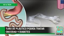 Investigadores británicos crean tubo de plástico para combatir obesidad y diabetes