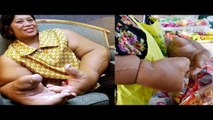 Extrañas enfermedades: Mujer tailandesa tiene el record de las manos mas grandes del mundo
