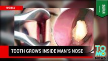 Hombre saudí con hiperodoncia tenia un diente extra creciendo en su nariz