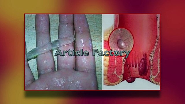 THIS IS THE BEST NATURAL CURE FOR HEMORRHOIDS! EVEN THE DOCTORS ARE AMAZED! | Hemorrhoid Treatment