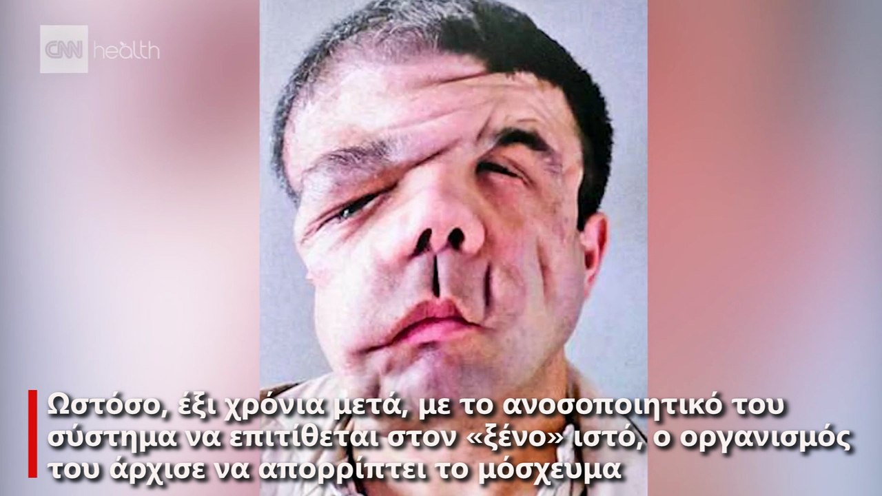 Ένας άνθρωπος, τρία πρόσωπα: Ο Ζερόμ Αμόν έγινε ο πρώτος άνθρωπος με δύο μεταμοσχεύσεις προσώπου