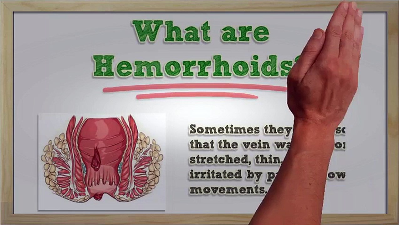 Hemorrhoids Symptoms - Hemorrhoids Symptoms and Treatment - Hemorrhoids Symptoms Itching | Hemorrhoid Treatment