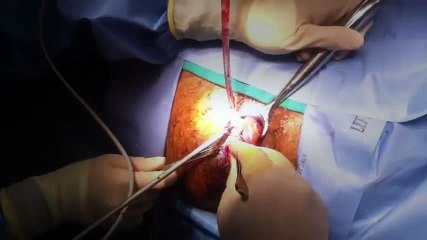 Hemorrhoids  Surgical Removal With Harmonic Scalpel | Hemorrhoid Treatment