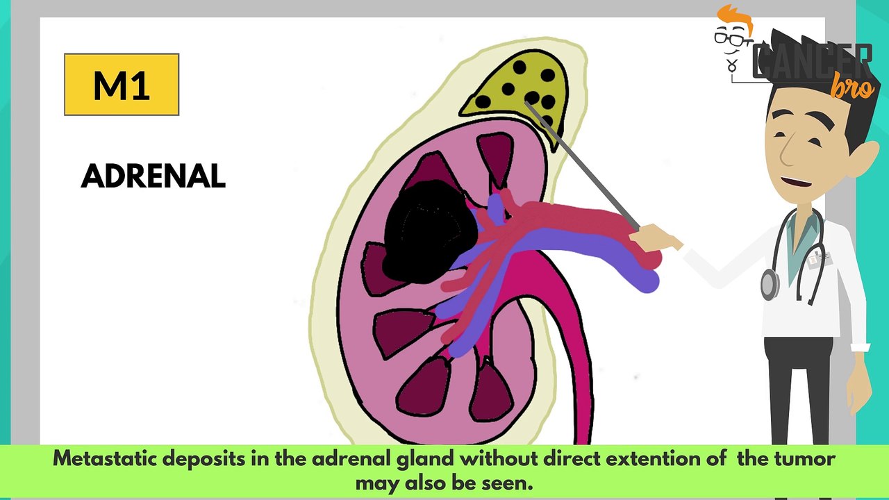 CancerBro explains treatment for metastatic kidney cancer