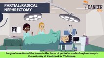 CancerBro explains treatment for non metastatic kidney cancer