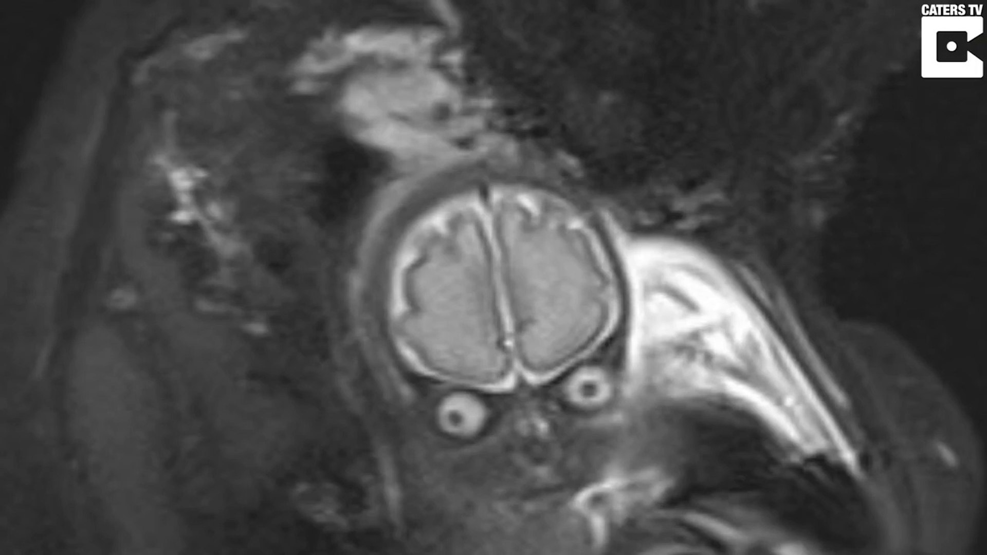 Elle Fait Faire Une Irm Du Cerveau A Son Bebe Et Va Avoir La Peur De Sa Vie Video Dailymotion