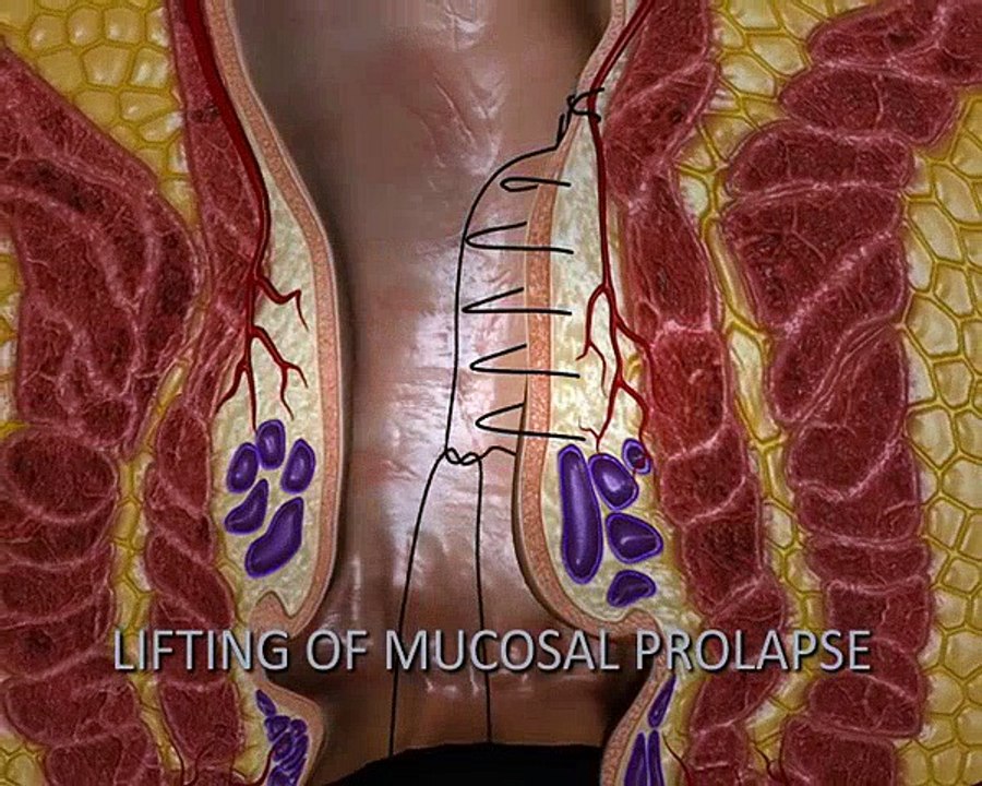 THD Hemorrhoid Procedure | Hemorrhoid Treatment