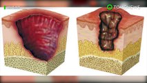 Infeksi pemakan daging meningkat di Australia: Buruli ulcer - TomoNews