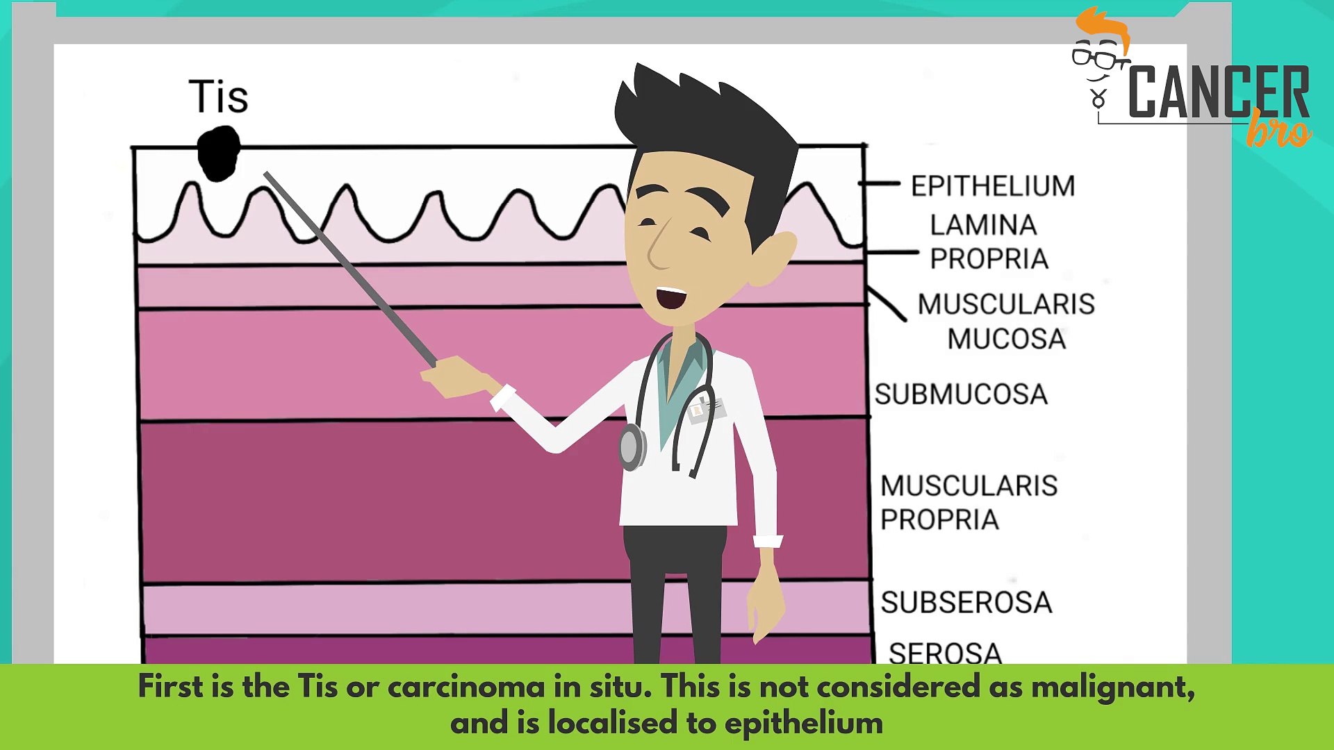 Stomach cancer staging