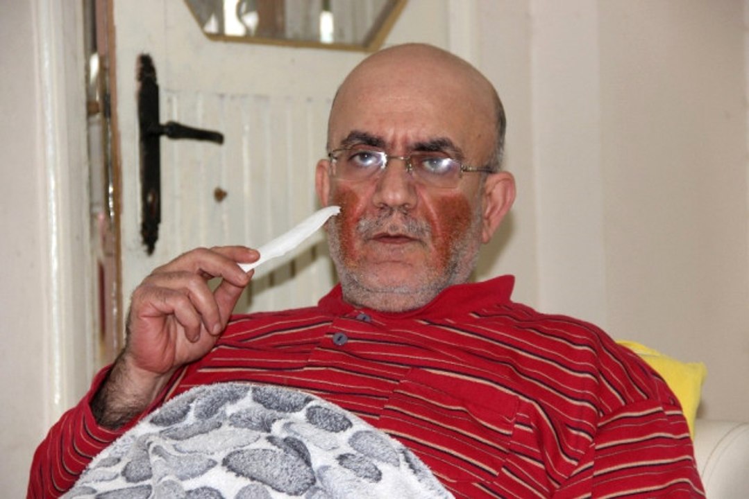 Yüzünde Çıkan Yaralar Nedeniyle Günden Güne Eriyor Dailymotion Video