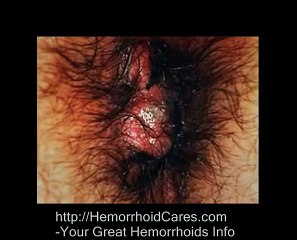 What is Thrombosed Hemorrhoid? | Hemorrhoid Treatment