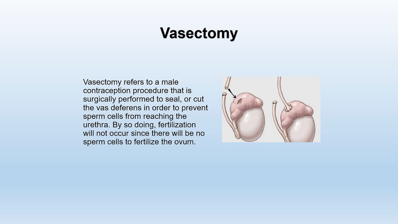Vasectomy Reversal - The Basic You Should Know