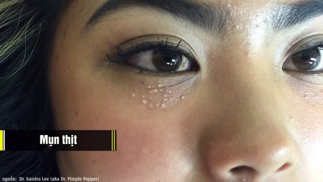 Những loại mụn trông “chướng mắt” nhưng tuyệt đối không nên nặn